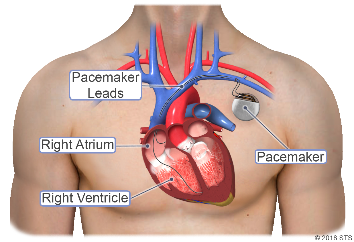 Is It Dangerous To Have Surgery With Afib